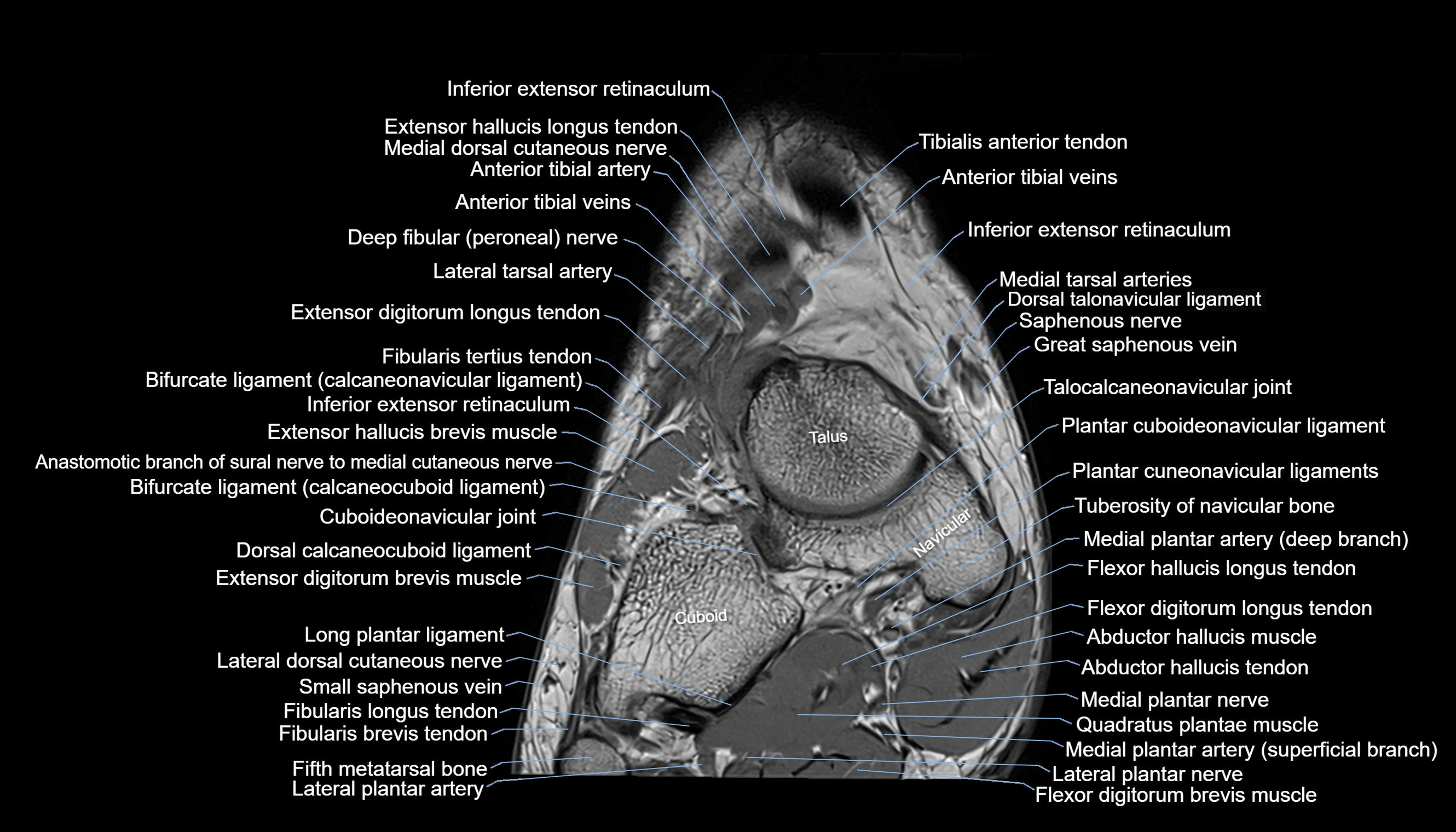 Ankle coronal anatomy 3T MRI images -img-11001-00001.webp